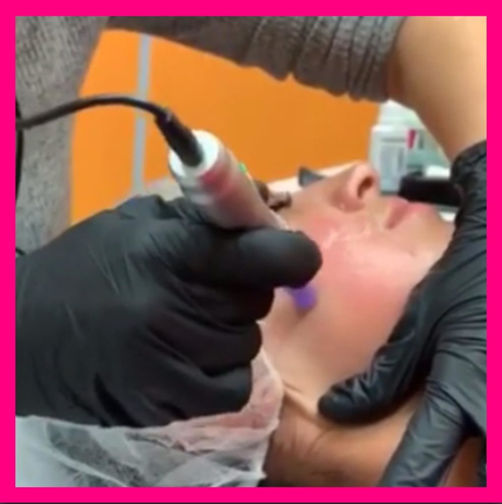 Microneedling Hanau